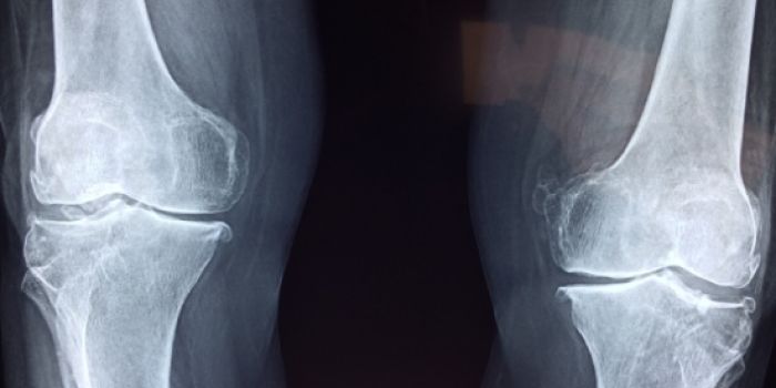 Osteoporosi Patologia prevenzione